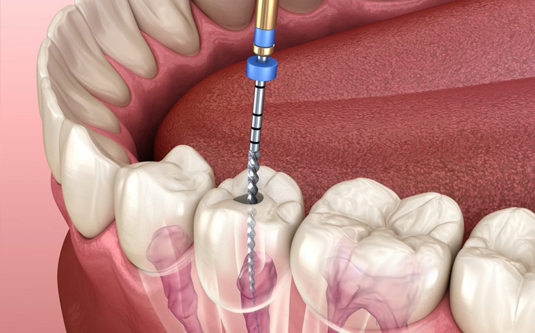 root canal treatment