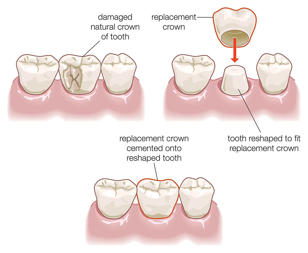 Dental crown