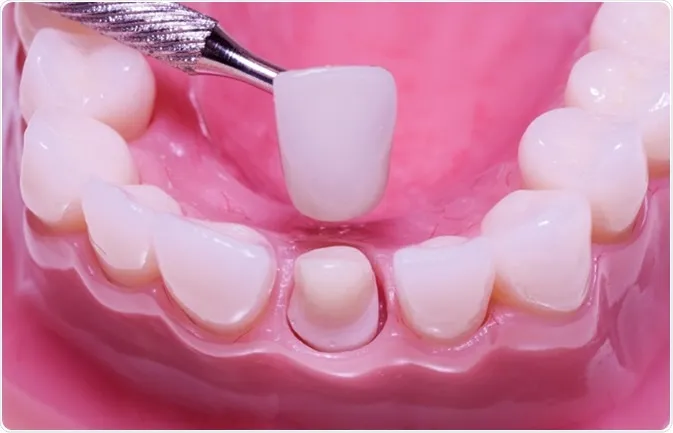 dental crowns